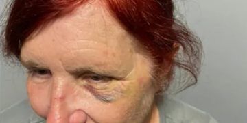 Elderly worker was left with black eye after she tried to stop shoplifter who repeatedly punched her in the face, then she was fired because of this policy!