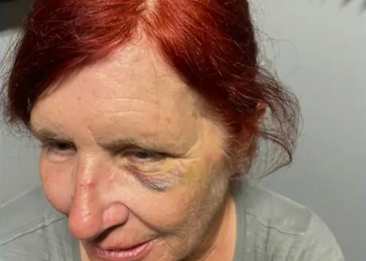 Elderly worker was left with black eye after she tried to stop shoplifter who repeatedly punched her in the face, then she was fired because of this policy!
